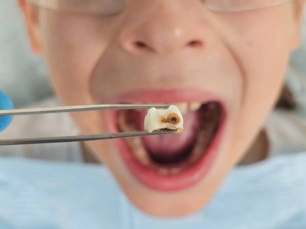 Best Broken or Chipped Tooth Repair in Bernice, LA